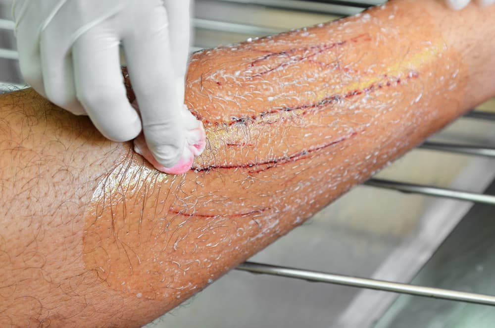 Cat-bite-wound-scrub